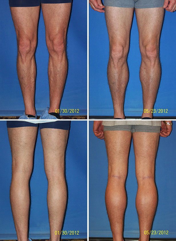Before and After Image: Calf Augmentation - other