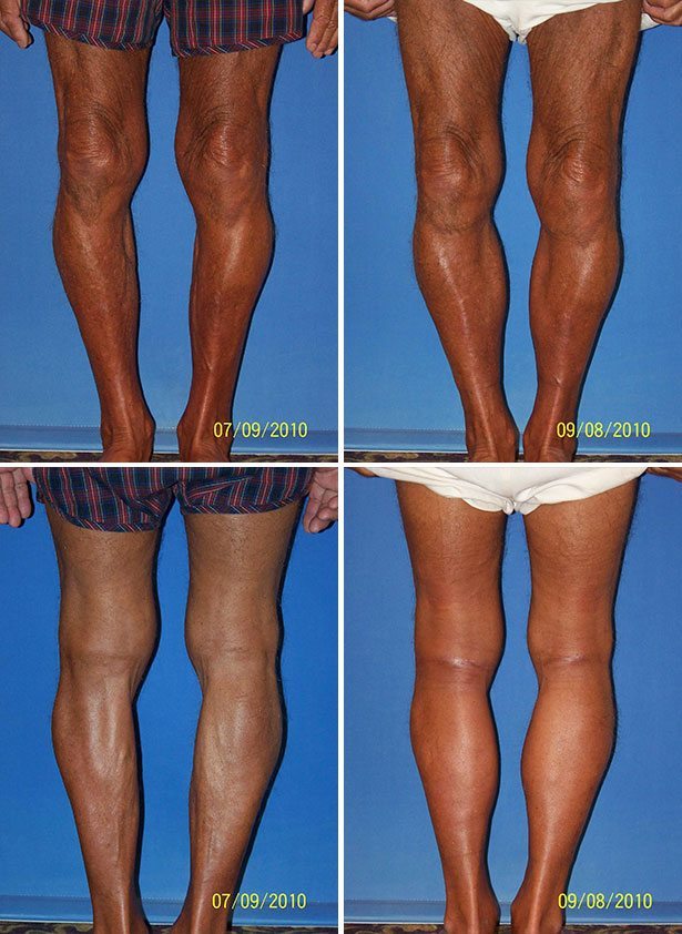 Before and After Image: Calf Augmentation - other