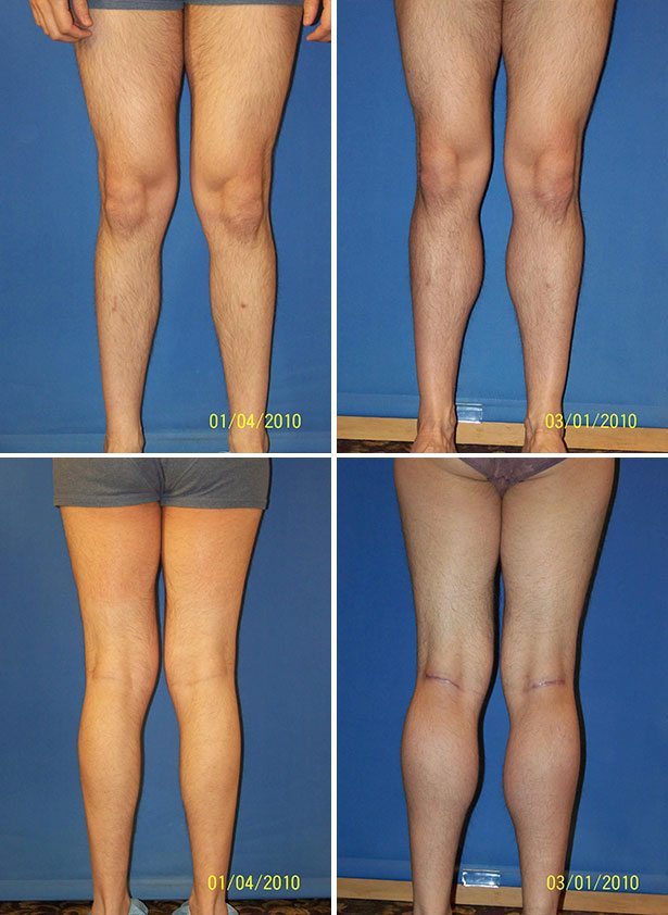 Before and After Image: Calf Augmentation - other