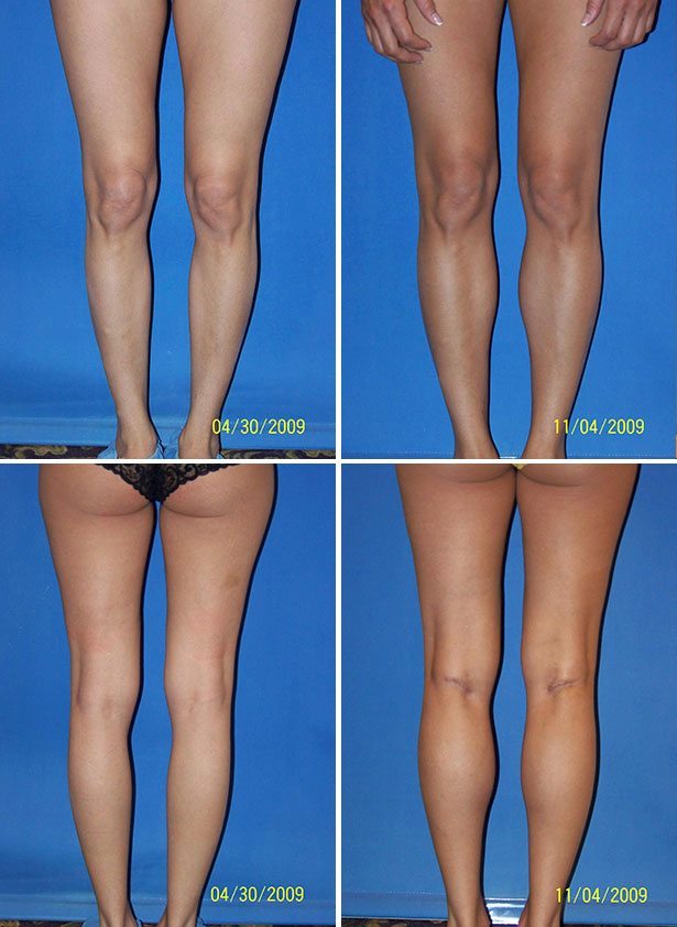 Before and After Image: Calf Augmentation - other