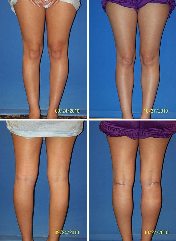 Before and After Image: Calf Augmentation - other
