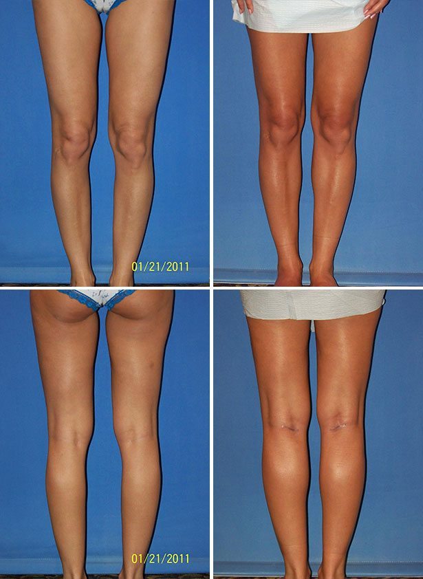 Before and After Image: Calf Augmentation - other