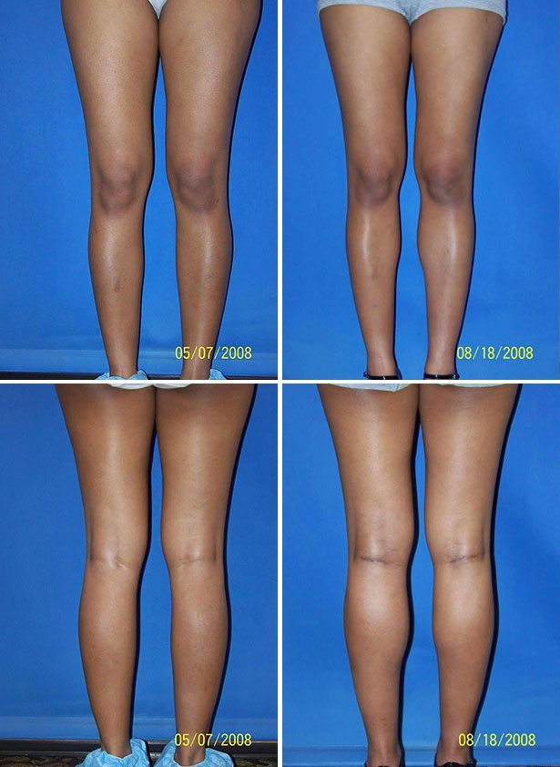 Before and After Image: Calf Augmentation - other
