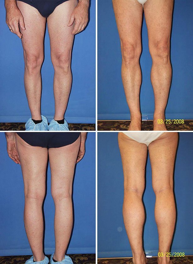 Before and After Image: Calf Augmentation - other