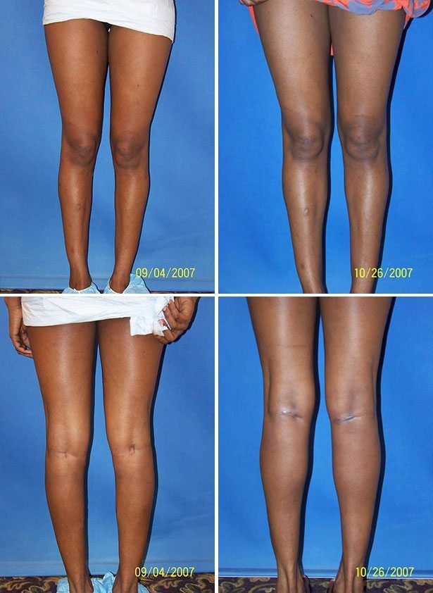Before and After Image: Calf Augmentation - other