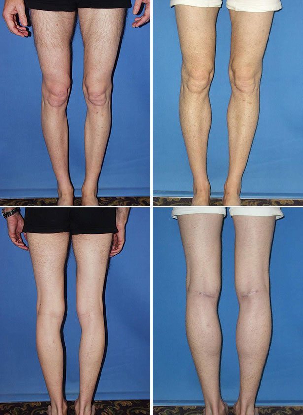 Before and After Image: Calf Augmentation - other