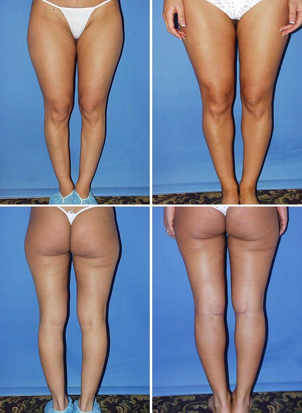 Before and After Image: Calf Augmentation - other