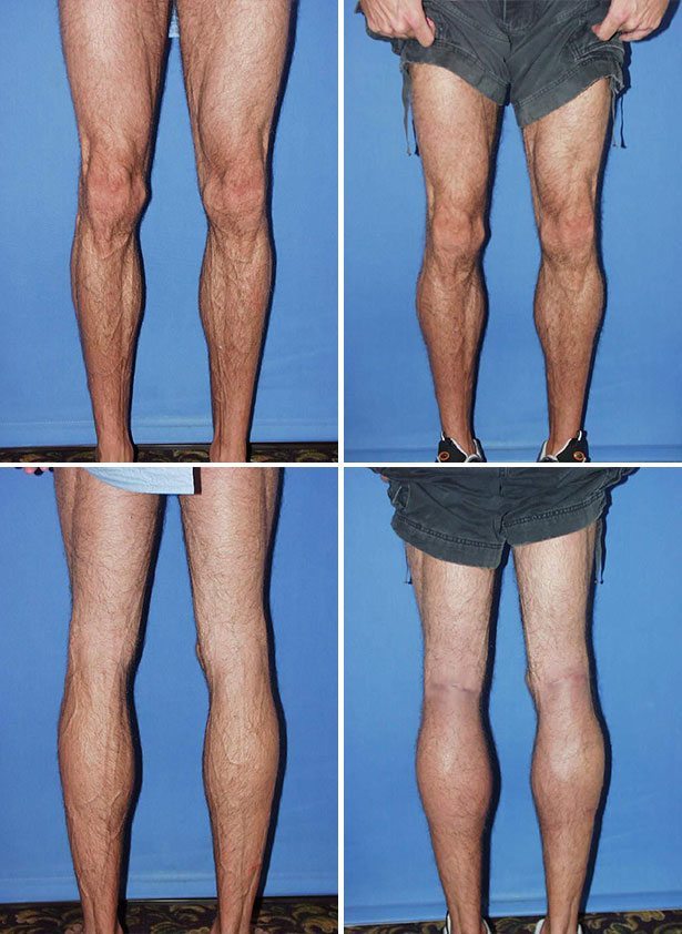 Before and After Image: Calf Augmentation - other