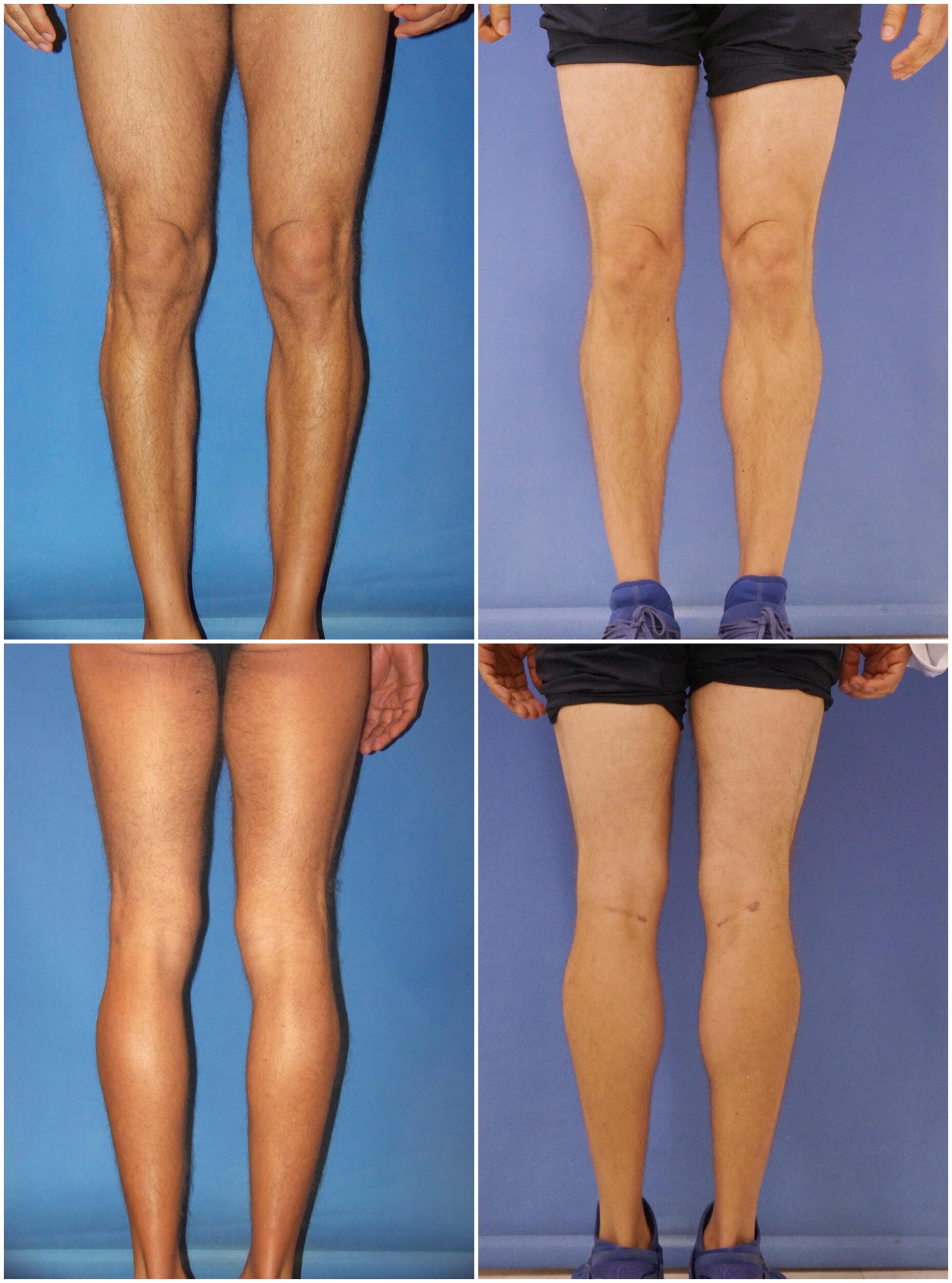 Before and After Image: Calf Augmentation - other