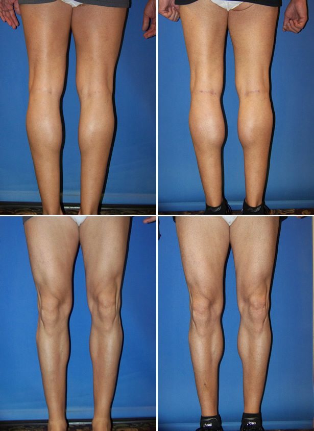 Before and After Image: Calf Augmentation - other