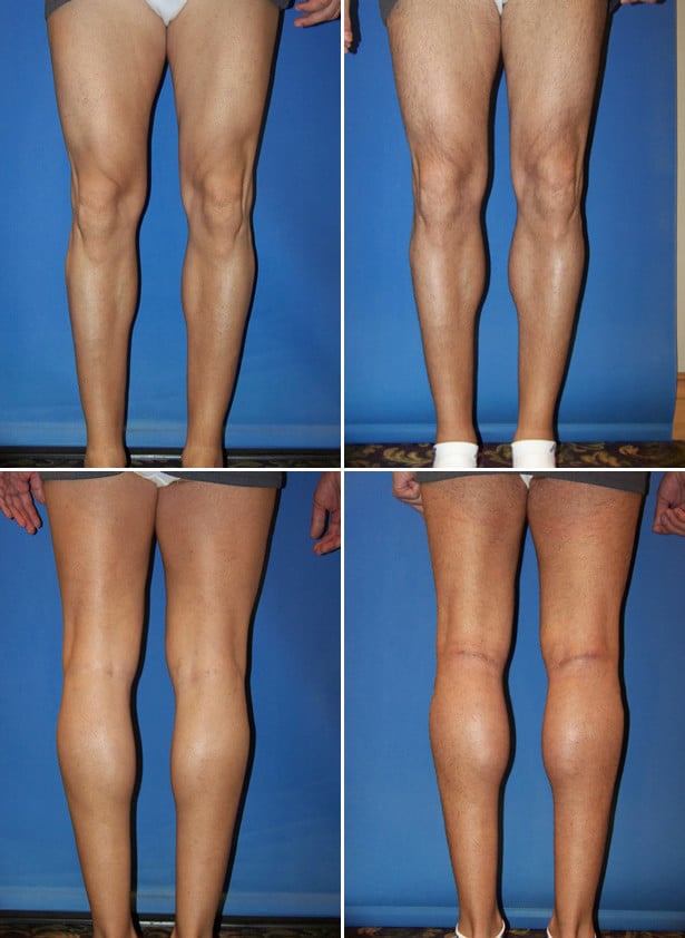 Before and After Image: Calf Augmentation - other
