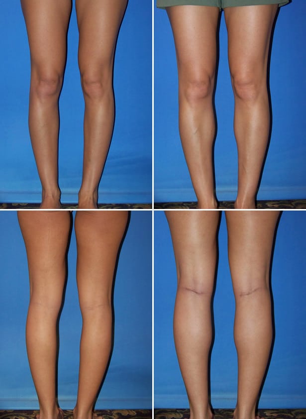 Before and After Image: Calf Augmentation - other