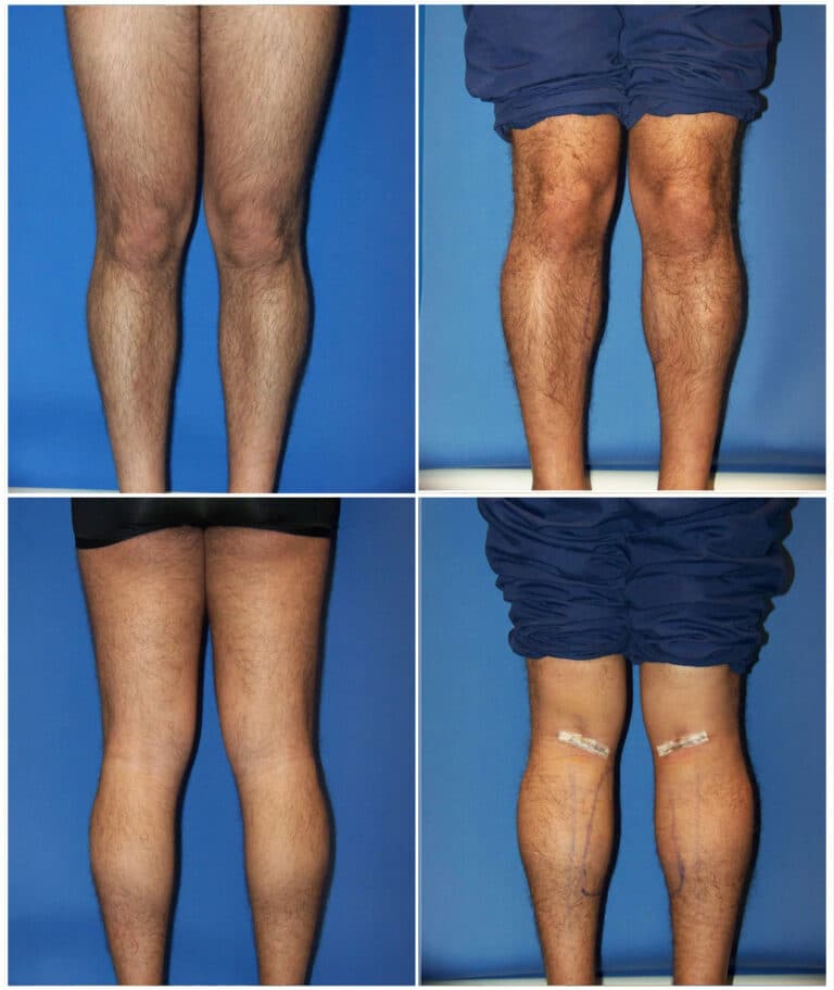 Before and After Image: Calf Augmentation - other