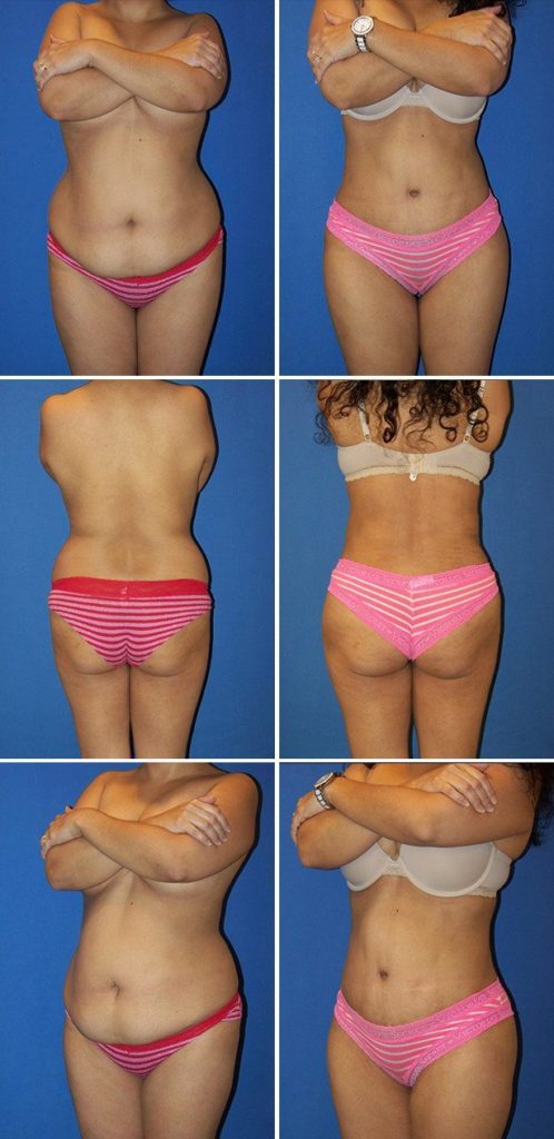 Before and After Image: Tummy Tuck (Abdominoplasty) - other