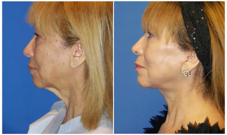 Before and After Image: Chin Augmentation Surgery - left-side