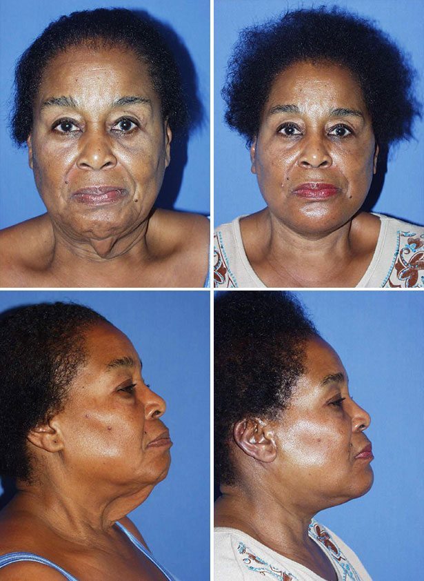 Before and After Image: Neck Lift Surgery - other
