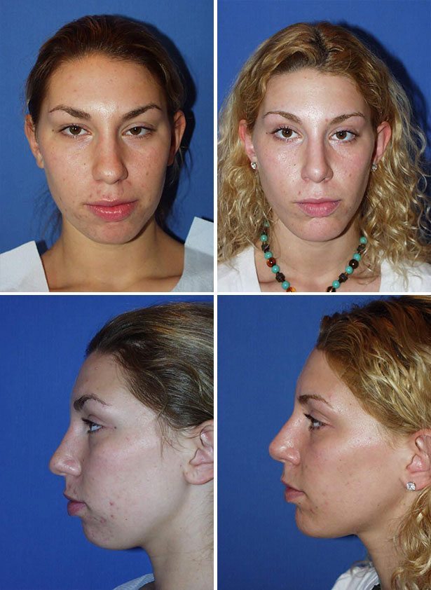 Before and After Image: Chin Augmentation Surgery - other