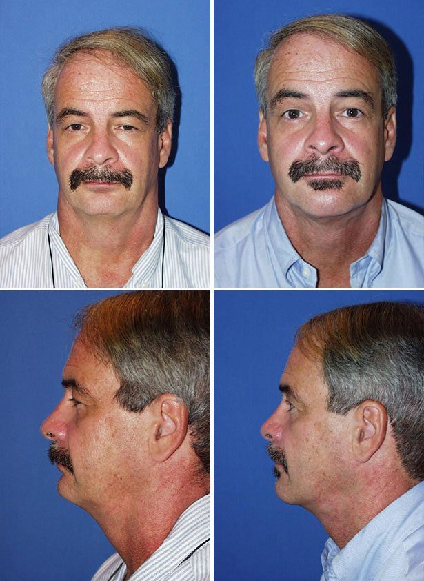 Before and After Image: Chin Augmentation Surgery - other