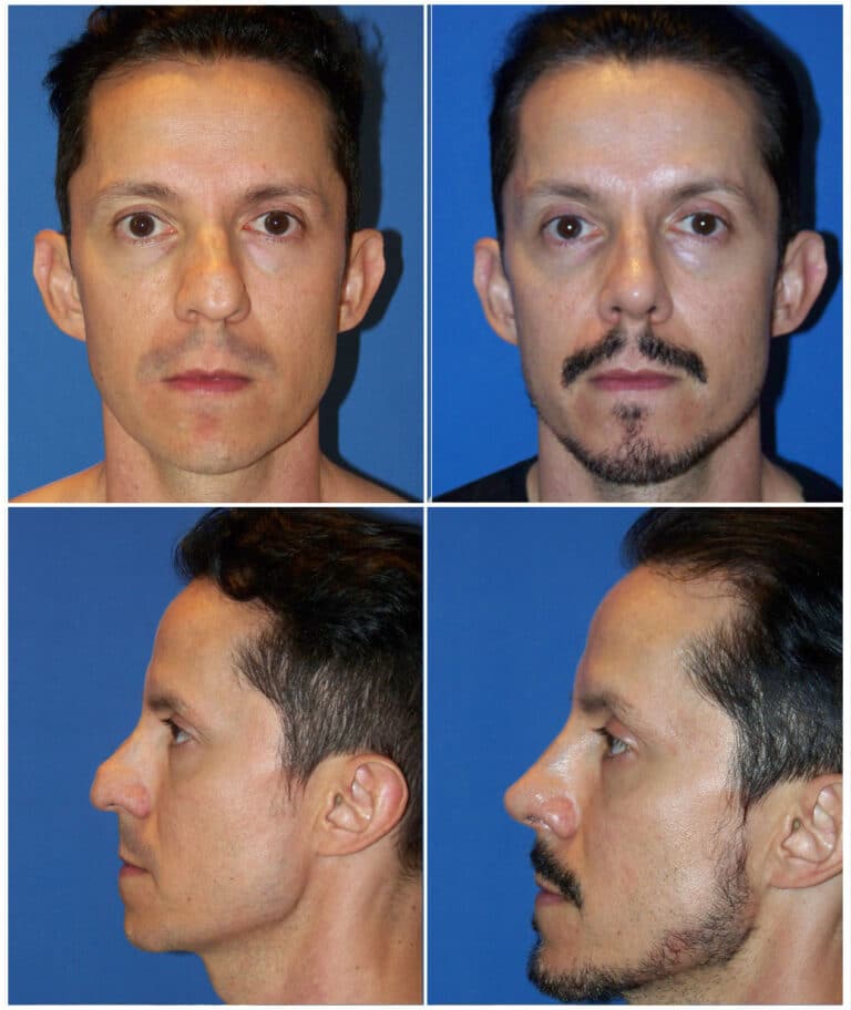 Before and After Image: Chin Augmentation Surgery - other