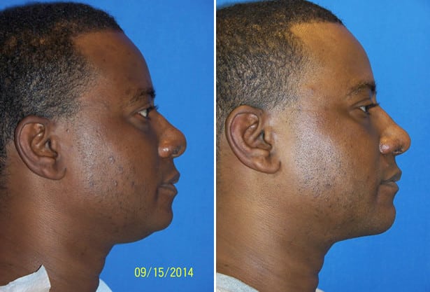 Before and After Image: Neck Liposuction Surgery - right-side