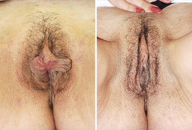 Before and After Image: Labiaplasty - front
