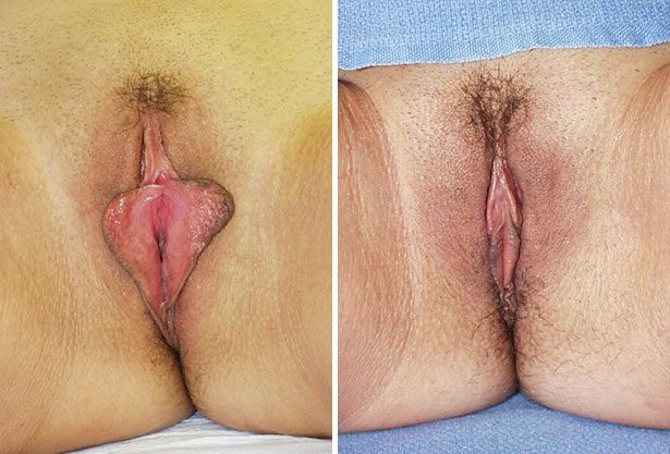 Before and After Image: Labiaplasty - front
