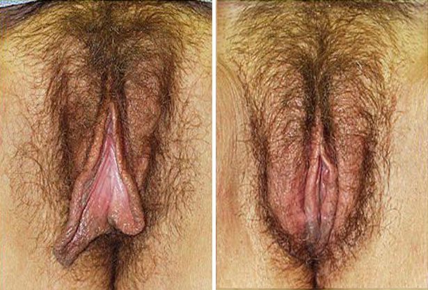 Before and After Image: Labiaplasty - front