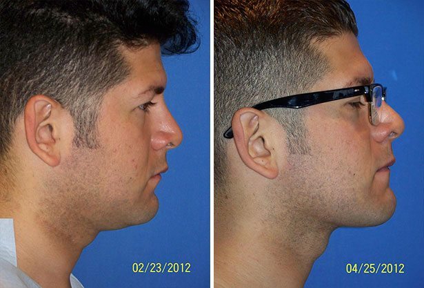 Before and After Image: Neck Liposuction Surgery - right-side