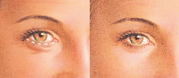 drgershenbaum lower eyelids 2 Cosmetic Eyelid Surgery in Miami, FL