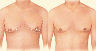 drgershenbaum male gynecomastia procedures1 1 Male Breast Reduction (Gynecomastia)