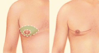 drgershenbaum male gynecomastia procedures2 334x179 2 Male Breast Reduction (Gynecomastia)