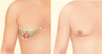 drgershenbaum male gynecomastia procedures3 334x179 3 Male Breast Reduction (Gynecomastia)