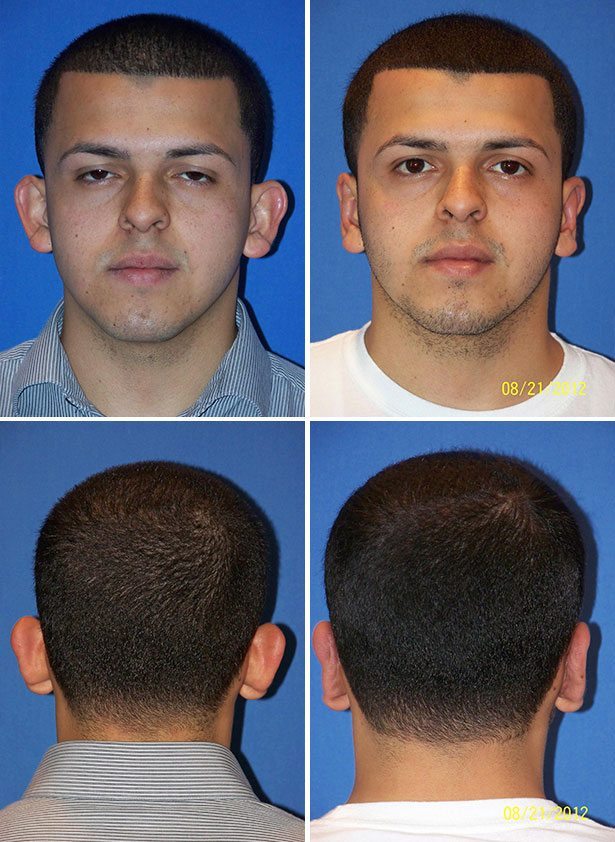 Before and After Image: Ear Surgery (Otoplasty) - other