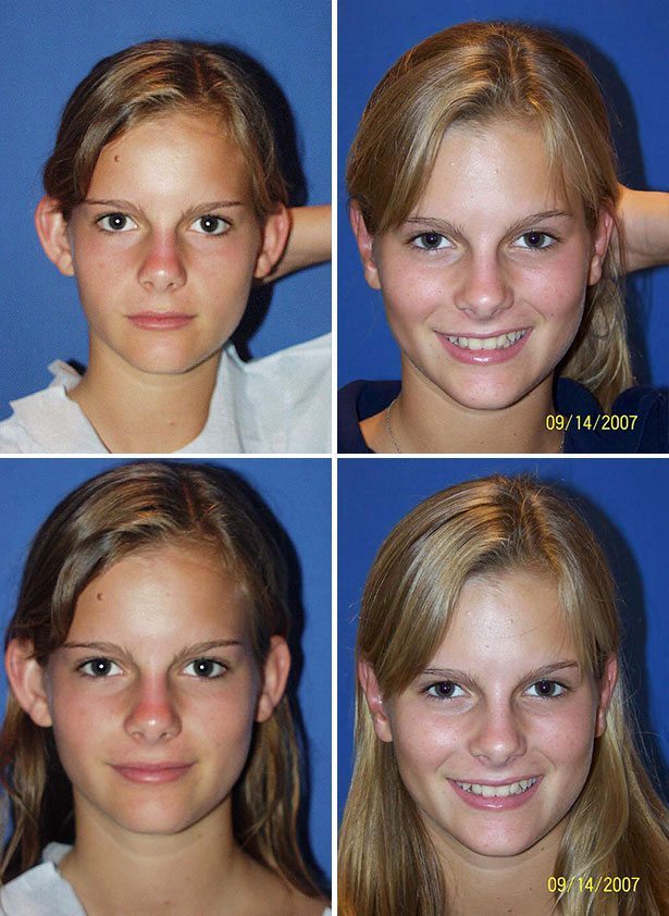Before and After Image: Ear Surgery (Otoplasty) - other