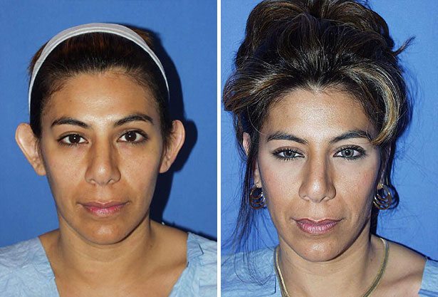 Before and After Image: Ear Surgery (Otoplasty) - front