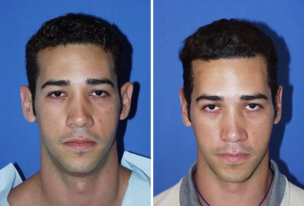 Before and After Image: Ear Surgery (Otoplasty) - front