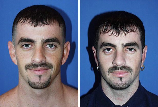 Before and After Image: Ear Surgery (Otoplasty) - front