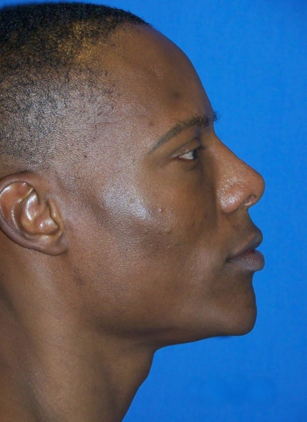 ethnic-rhino-2b ethnic rhino 2b Ethnic Rhinoplasty in Miami, FL