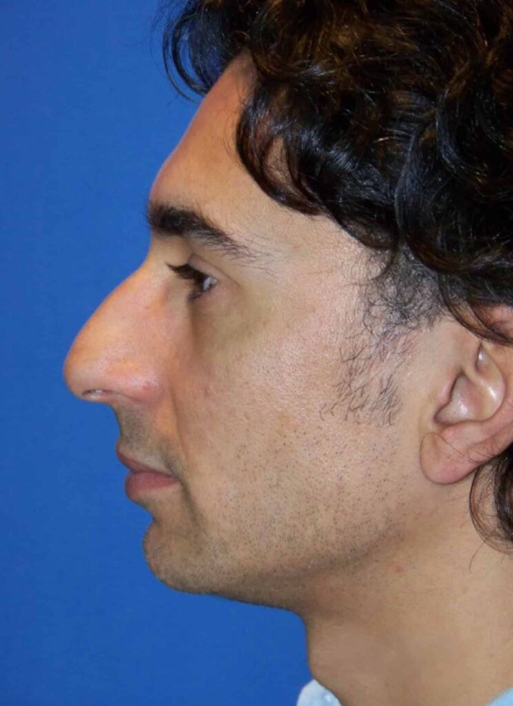 ethnic-rhino-3a ethnic rhino 3a Ethnic Rhinoplasty in Miami, FL