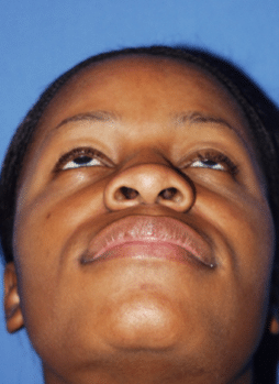 ethnic-rhino-4a ethnic rhino 4a Ethnic Rhinoplasty in Miami, FL