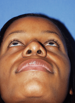 ethnic-rhino-4b ethnic rhino 4b Ethnic Rhinoplasty in Miami, FL