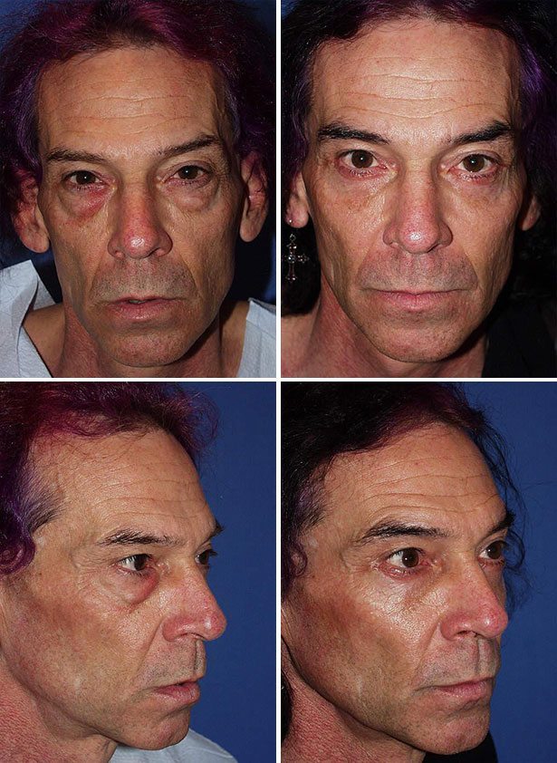 Before and After Image: Eyelid Lift Surgery (Blepharoplasty) - other