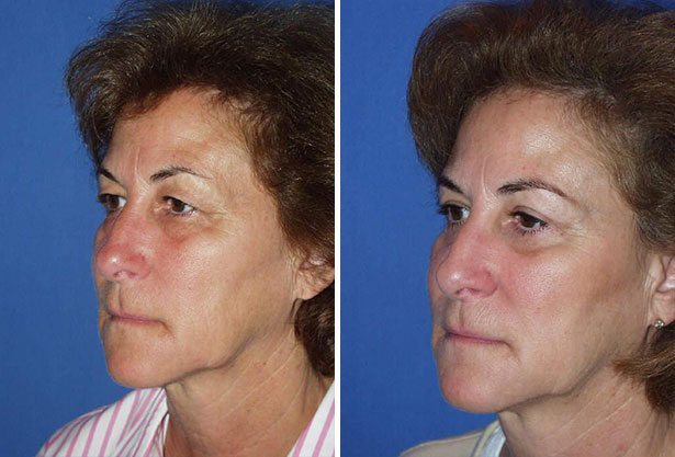Before and After Image: Eyelid Lift Surgery (Blepharoplasty) - left-front-oblique