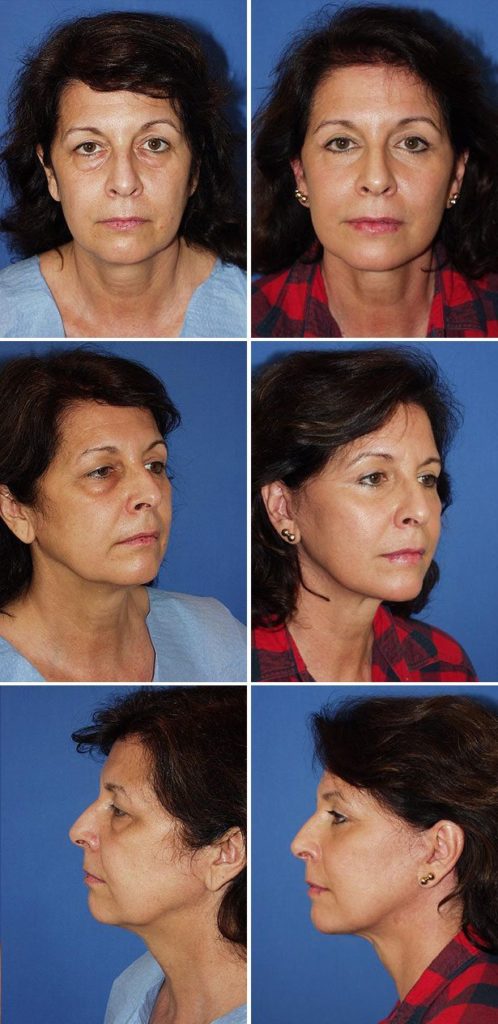 Before and After Image: Eyelid Lift Surgery (Blepharoplasty) - other