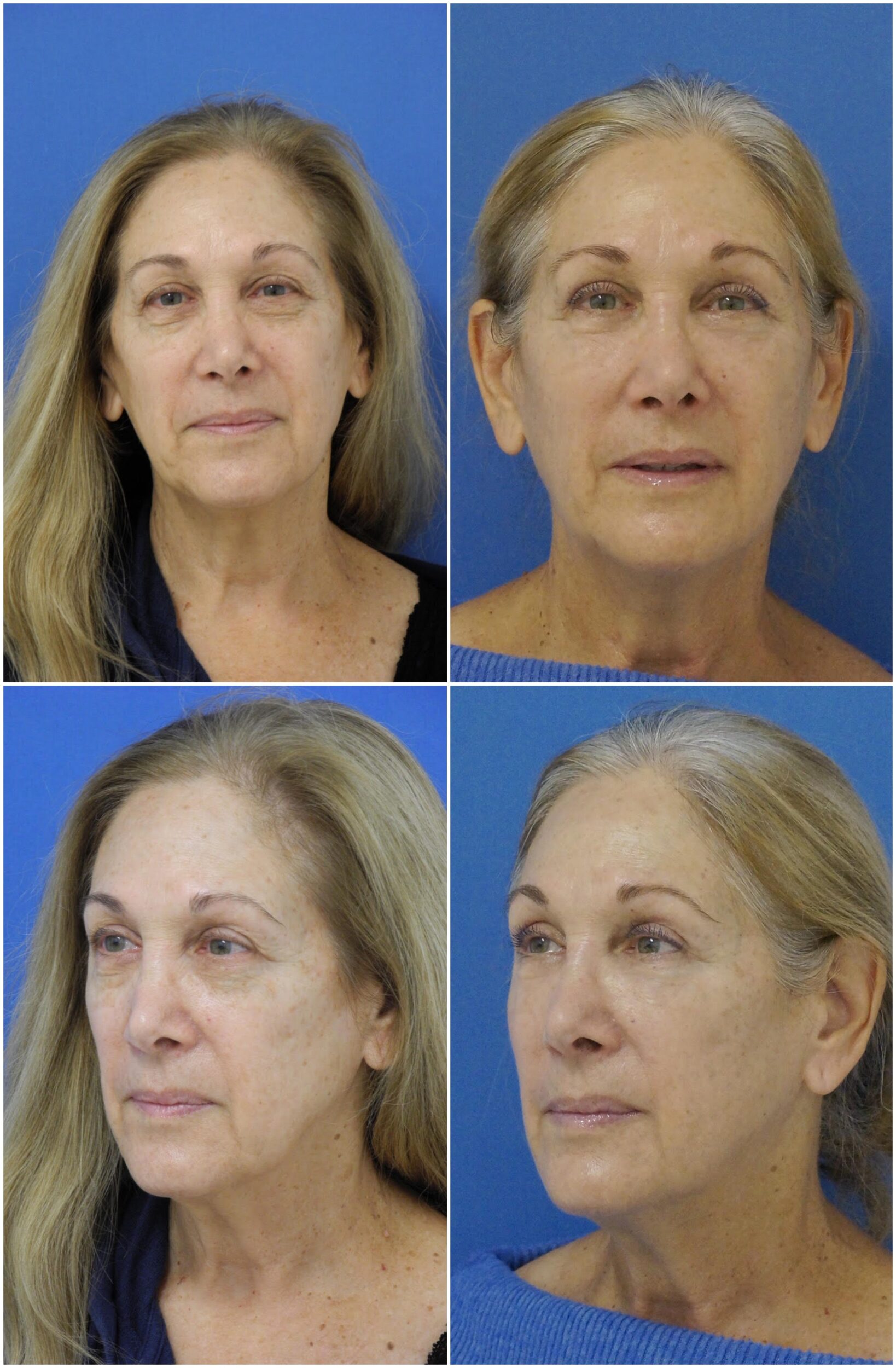 Before and After Image: Eyelid Lift Surgery (Blepharoplasty) - other