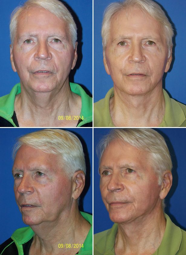 Before and After Image: Facelift Surgery - other