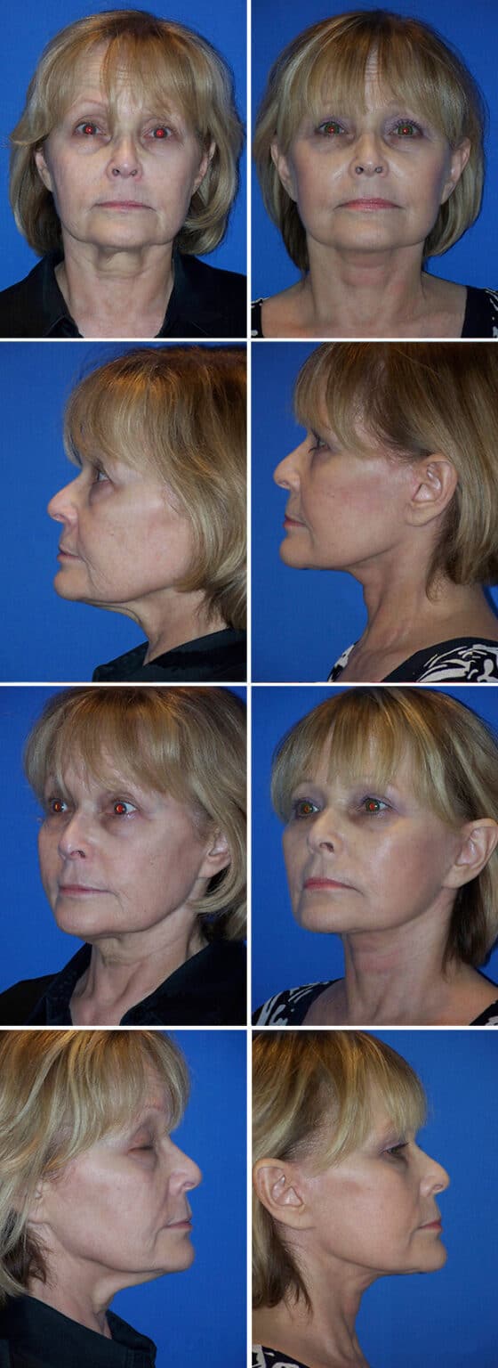 Before and After Image: Facelift Surgery - other