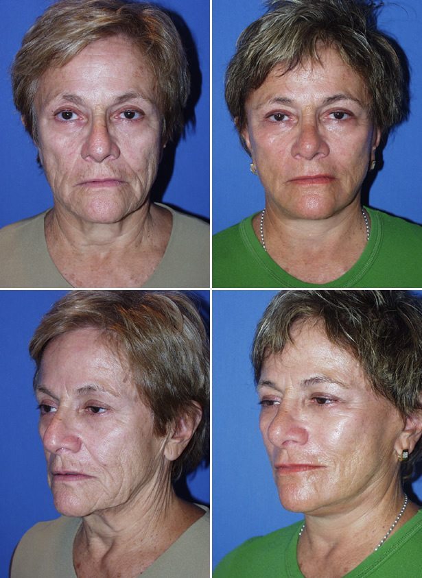 Before and After Image: Facelift Surgery - other