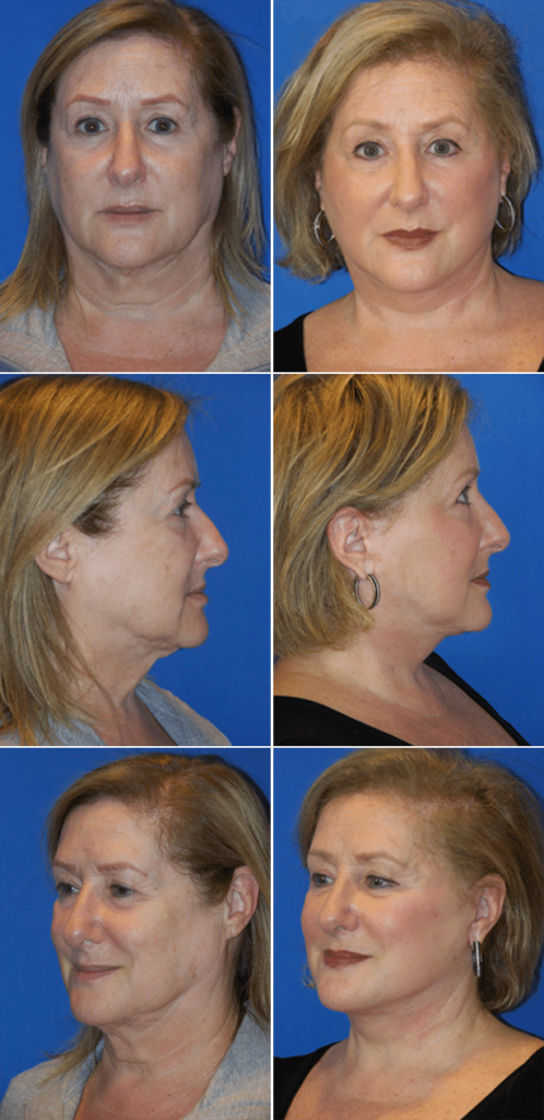 Before and After Image: Facelift Surgery - other