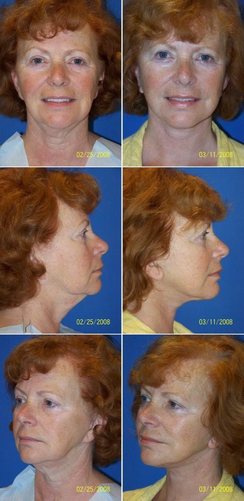 Before and After Image: Facelift Surgery - other